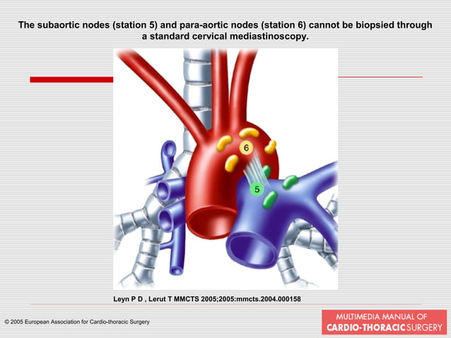 Mediastinoscopy & mediastinotomy indications & techniques | PPT | Lung ...