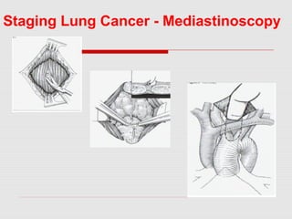 Mediastinoscopy & mediastinotomy indications & techniques | PPT