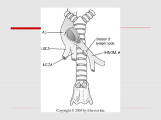 Mediastinoscopy & mediastinotomy indications & techniques | PPT