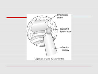 Mediastinoscopy & mediastinotomy indications & techniques | PPT
