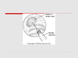 Mediastinoscopy & mediastinotomy indications & techniques | PPT