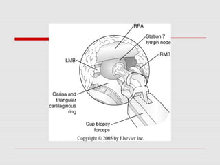 Mediastinoscopy & mediastinotomy indications & techniques | PPT