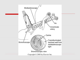 Mediastinoscopy & mediastinotomy indications & techniques | PPT