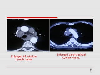 Ap Window Node Mediastinoscopy & mediastinotomy indications & techniques | PPT