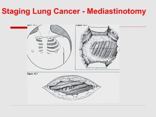 Mediastinoscopy & mediastinotomy indications & techniques | PPT