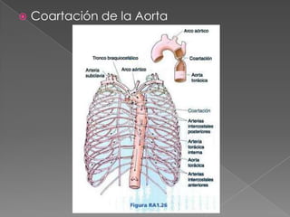    Coartación de la Aorta
 