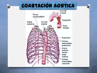Coartación aortica
 