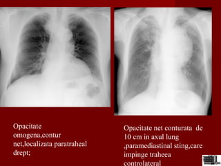 Opacitate
omogena,contur
net,localizata paratraheal
drept;
Opacitate net conturata de
10 cm in axul lung
,paramediastinal sting,care
impinge traheea
controlateral
 