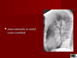  masa tumorala in santulmasa tumorala in santul
costo-vertebralcosto-vertebral
 