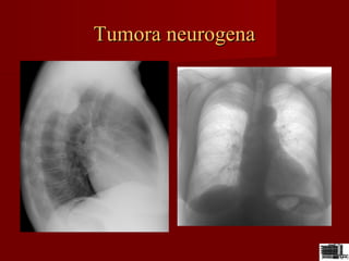 Tumora neurogenaTumora neurogena
 