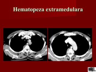 Hematopeza extramedularaHematopeza extramedulara
 