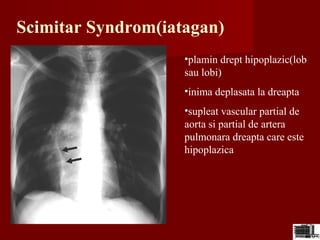 Scimitar Syndrom(iatagan)
•plamin drept hipoplazic(lob
sau lobi)
•inima deplasata la dreapta
•supleat vascular partial de
aorta si partial de artera
pulmonara dreapta care este
hipoplazica
 