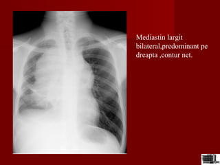 Mediastin largit
bilateral,predominant pe
dreapta ,contur net.
 