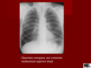Opacitate omogena ,net conturata
mediastinal superior drept
 
