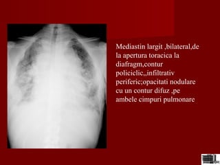 Mediastin largit ,bilateral,de
la apertura toracica la
diafragm,contur
policiclic,,infiltrativ
periferic;opacitati nodulare
cu un contur difuz ,pe
ambele cimpuri pulmonare
 