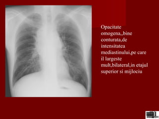 Opacitate
omogena,,bine
conturata,de
intensitatea
mediastinului,pe care
il largeste
mult,bilateral,in etajul
superior si mijlociu
 