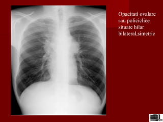 Opacitati ovalare
sau policiclice
situate hilar
bilateral,simetric
 