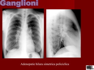 Adenopatie hilara simetrica policiclica
 