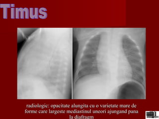 radiologic: opacitate alungita cu o varietate mare deradiologic: opacitate alungita cu o varietate mare de
forme care largeste mediastinul uneori ajungand panaforme care largeste mediastinul uneori ajungand pana
la diafragmla diafragm
 