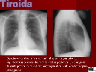 Opacitate localizata in mediastinul superior ,anterior,ce
ingusteaza si deviaza traheea lateral si posterior ,neomogena
datorita prezentei calcificarilor;diagnosticul este confirmat prin
scintigrafie
 