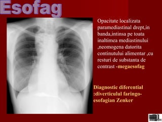 Opacitate localizata
paramediastinal drept,in
banda,intinsa pe toata
inaltimea mediastinului
,neomogena datorita
continutului alimentar ,cu
resturi de substanta de
contrast -megaesofag
Diagnostic diferential
:diverticulul faringo-
esofagian Zenker
 