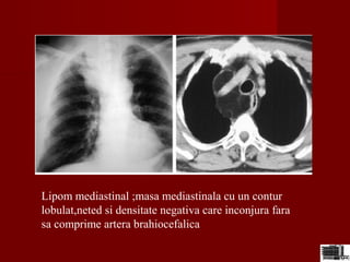 Lipom mediastinal ;masa mediastinala cu un contur
lobulat,neted si densitate negativa care inconjura fara
sa comprime artera brahiocefalica
 