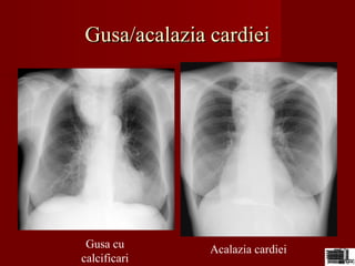 Gusa/acalazia cardieiGusa/acalazia cardiei
Gusa cu
calcificari
Acalazia cardiei
 