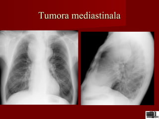 Tumora mediastinalaTumora mediastinala
 