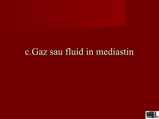 c.Gaz sau fluid in mediastinc.Gaz sau fluid in mediastin
 