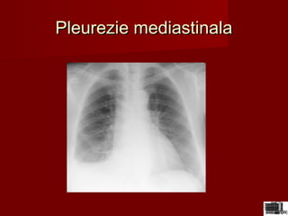 Pleurezie mediastinalaPleurezie mediastinala
 