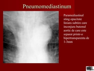PneumomediastinumPneumomediastinum
Paramediastinal
sting opacitate
liniara subtire care
inconjura butonul
aortic de care este
separat printr-o
hipertransparenta de
1-3mm
 