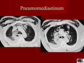 PneumomediastinumPneumomediastinum
 