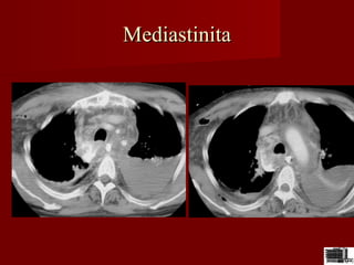MediastinitaMediastinita
 