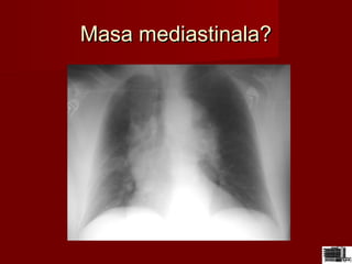 Masa mediastinala?Masa mediastinala?
 