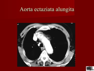 Aorta ectaziata alungitaAorta ectaziata alungita
 
