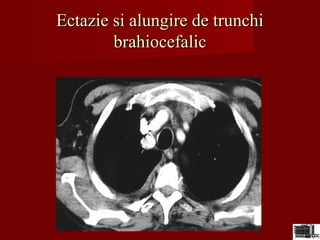 Ectazie si alungire de trunchiEctazie si alungire de trunchi
brahiocefalicbrahiocefalic
 