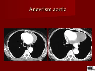 Anevrism aorticAnevrism aortic
 