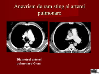 Anevrism de ram sting al artereiAnevrism de ram sting al arterei
pulmonarepulmonare
Diametrul arterei
pulmonare>3 cm
 