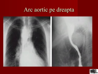 Arc aortic pe dreaptaArc aortic pe dreapta
 