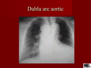 Dublu arc aorticDublu arc aortic
 