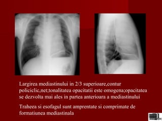 Largirea mediastinului in 2/3 superioare,contur
policiclic,net;tonalitatea opacitatii este omogena;opacitatea
se dezvolta mai ales in partea anterioara a mediastinului
Traheea si esofagul sunt amprentate si comprimate de
formatiunea mediastinala
 