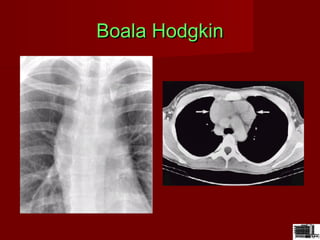 Boala HodgkinBoala Hodgkin
 
