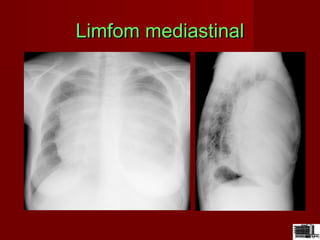 Limfom mediastinalLimfom mediastinal
 