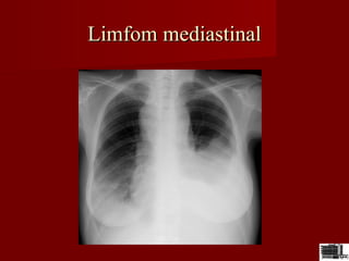 Limfom mediastinalLimfom mediastinal
 