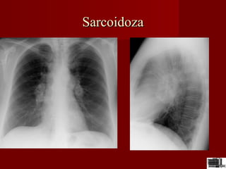 SarcoidozaSarcoidoza
 