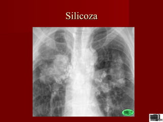 SilicozaSilicoza
 