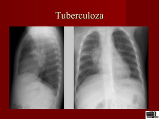 TuberculozaTuberculoza
 