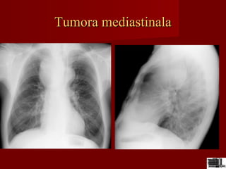 Tumora mediastinalaTumora mediastinala
 