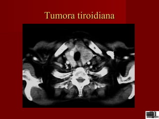 Tumora tiroidianaTumora tiroidiana
 