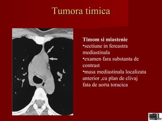 Tumora timicaTumora timica
Timom si miastenie
•sectiune in fereastra
mediastinala
•examen fara substanta de
contrast
•masa mediastinala localizata
anterior ,cu plan de clivaj
fata de aorta toracica
 